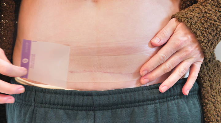Image of mom with c-section scar applying a c-section recovery pad